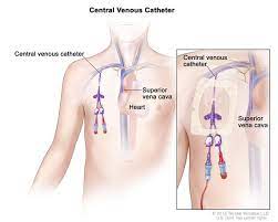 Central Vein Catheterizations